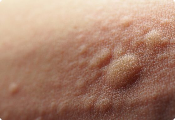 Blizszy widok na skórę z trądzikiem i zaskórnikami.