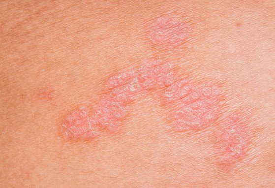 Sucha i podrażniona skóra z zmianami łuszczącymi się, problem dermatologiczny.